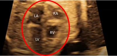 Numerical Investigation of the Fetal Left Heart Hemodynamics During Gestational Stages